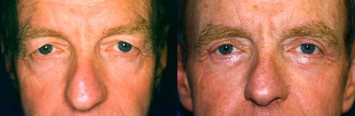 Male Eyelid Surgery Before & After Gallery - Patient 122406222 - Image 1