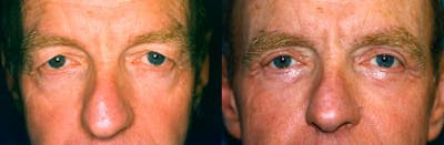 Male Eyelid Surgery Before & After Gallery - Patient 122406222 - Image 1