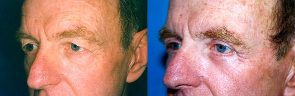 Male Eyelid Surgery Before & After Gallery - Patient 122406222 - Image 2