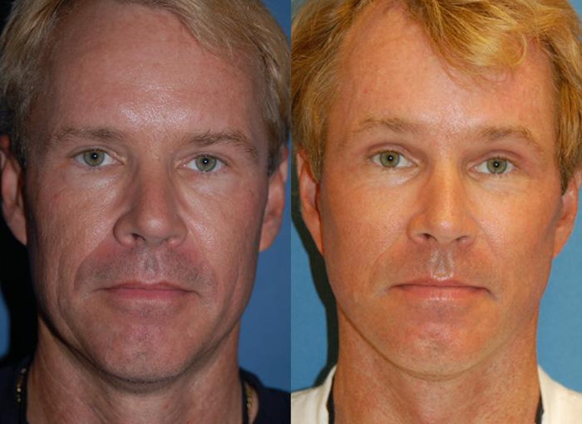 Male Facelift Before & After Gallery - Patient 122406224 - Image 1