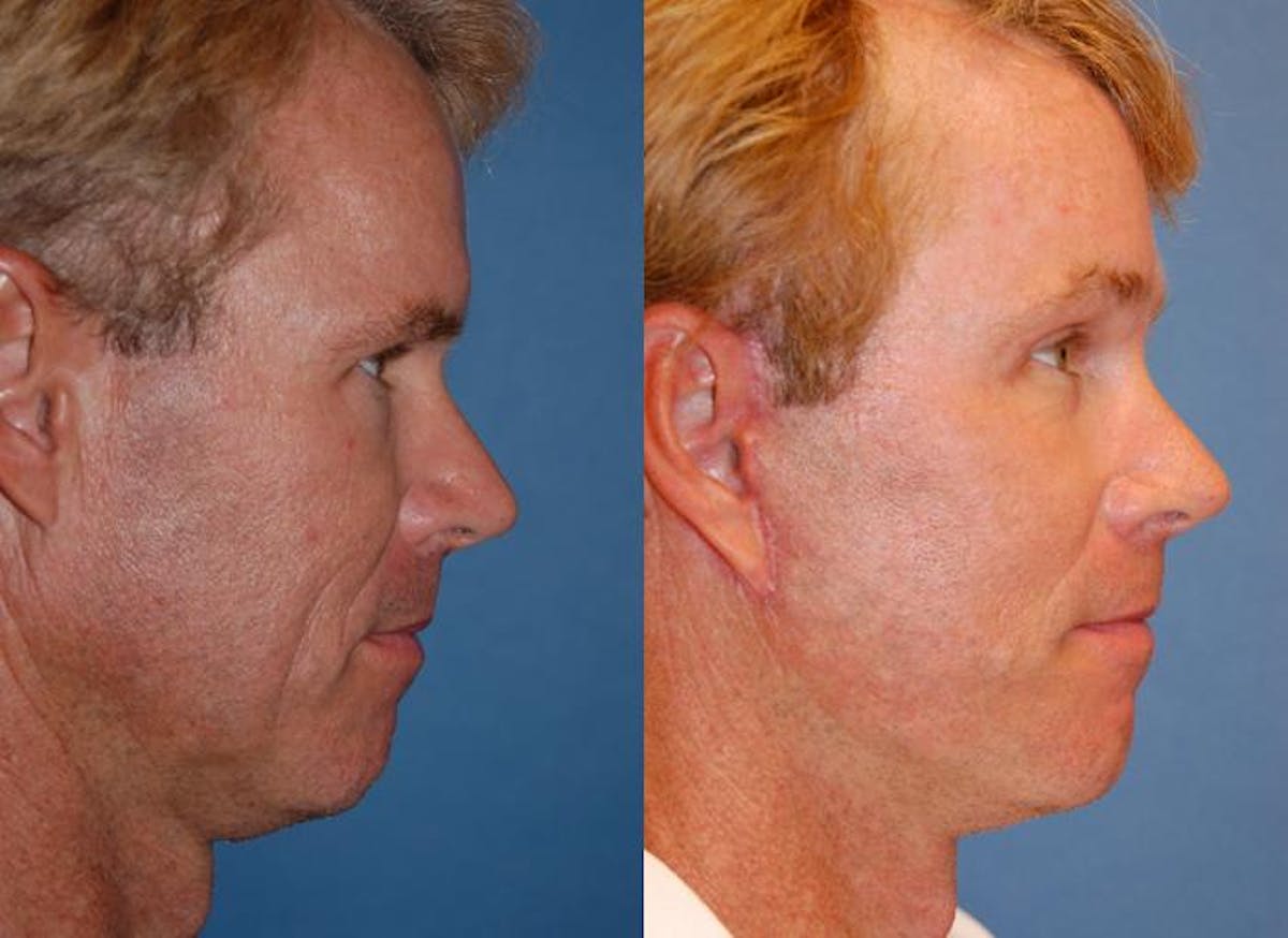 Male Facelift Before & After Gallery - Patient 122406224 - Image 2