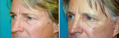 Male Eyelid Surgery Before & After Gallery - Patient 122406225 - Image 1