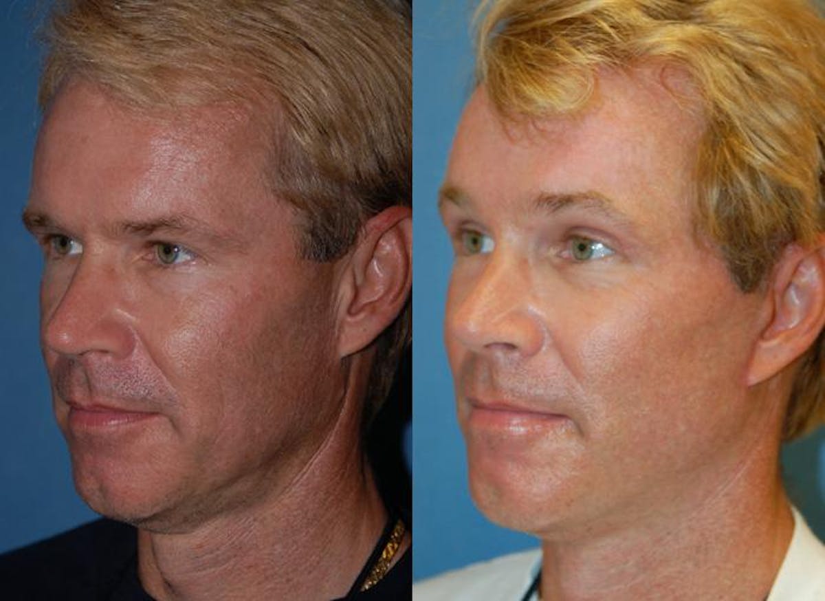 Male Facelift Before & After Gallery - Patient 122406224 - Image 3