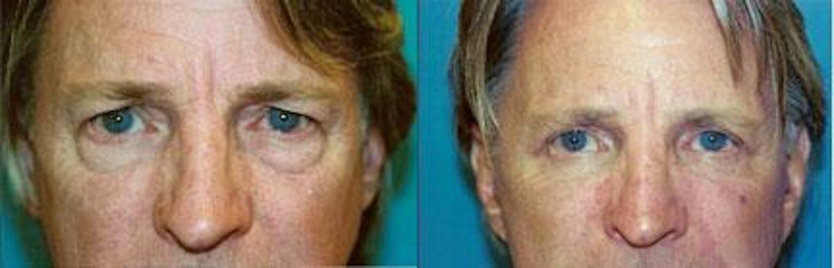 Male Eyelid Surgery Before & After Gallery - Patient 122406225 - Image 2