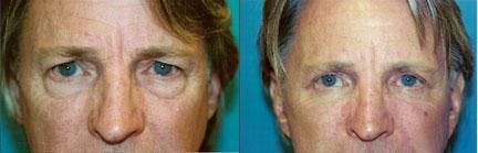 Male Eyelid Surgery Before & After Gallery - Patient 122406225 - Image 2