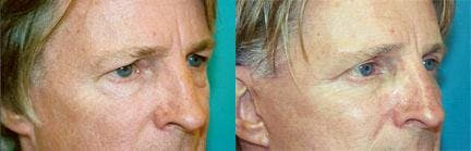Male Eyelid Surgery Before & After Gallery - Patient 122406225 - Image 3