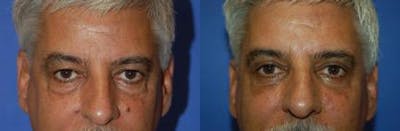 Male Eyelid Surgery Before & After Gallery - Patient 122406227 - Image 1