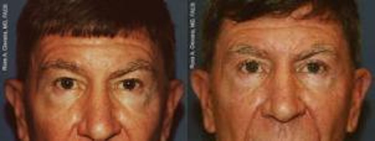 Male Eyelid Surgery Before & After Gallery - Patient 122406229 - Image 1