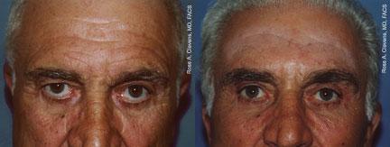 Male Eyelid Surgery Before & After Gallery - Patient 122406230 - Image 1