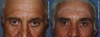 Male Eyelid Surgery Before & After Gallery - Patient 122406230 - Image 1