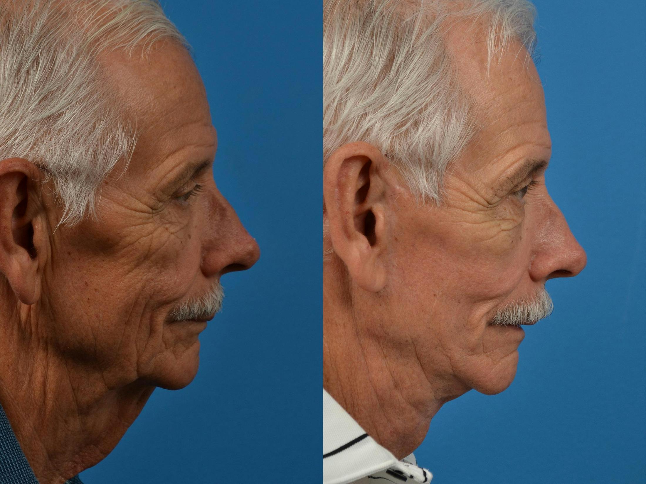 Male Facelift Before & After Gallery - Patient 122406235 - Image 2
