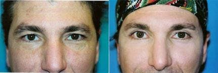Male Eyelid Surgery Before & After Gallery - Patient 122406231 - Image 1