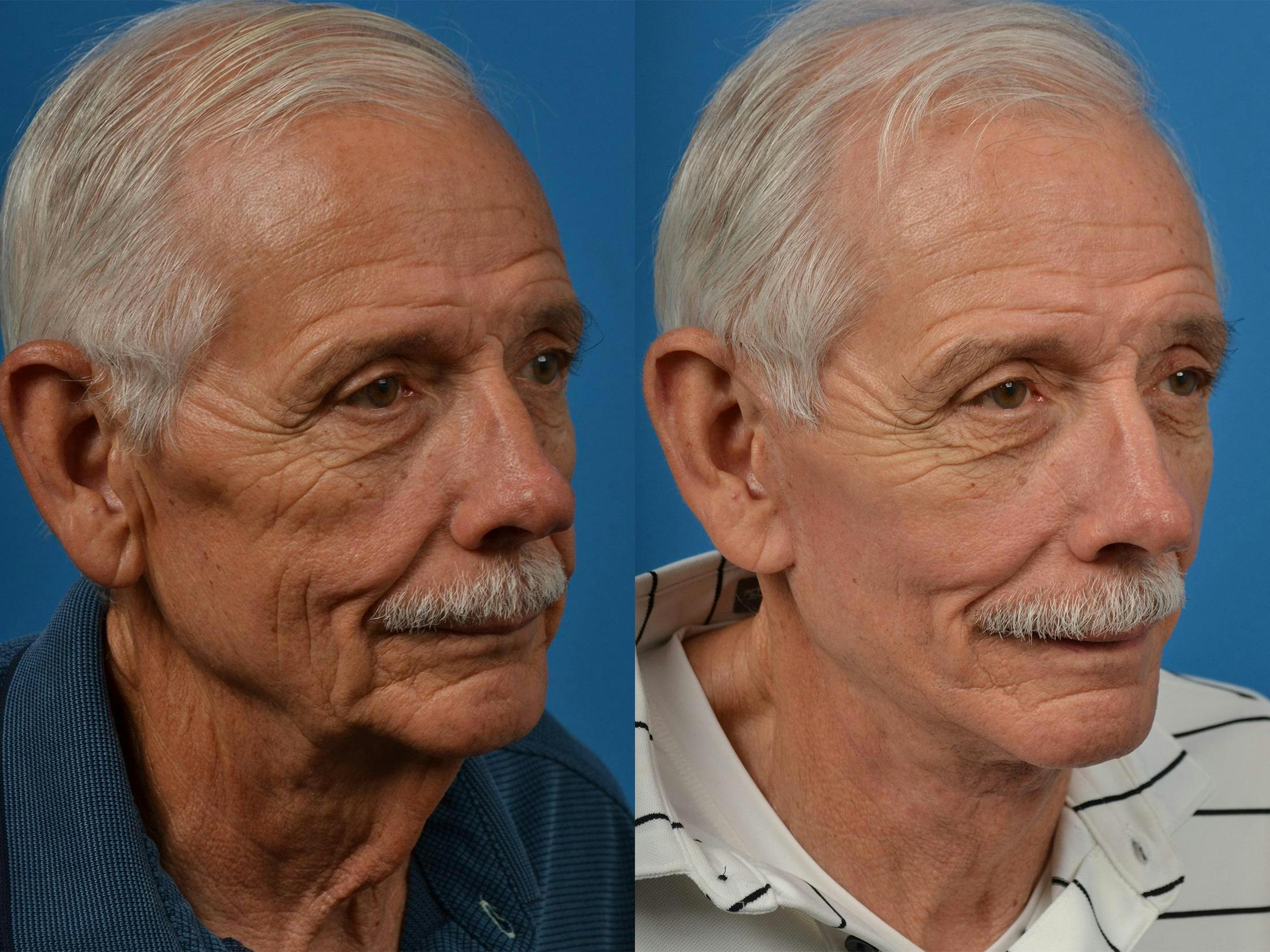 Male Facelift Before & After Gallery - Patient 122406235 - Image 3