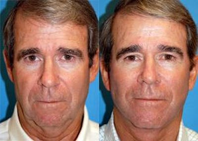 Male Facelift Before & After Gallery - Patient 122406239 - Image 1