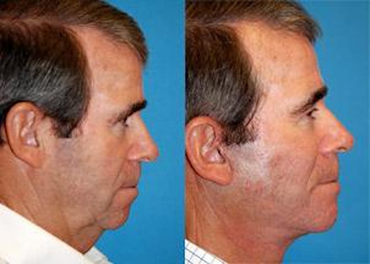 Male Facelift Before & After Gallery - Patient 122406239 - Image 2