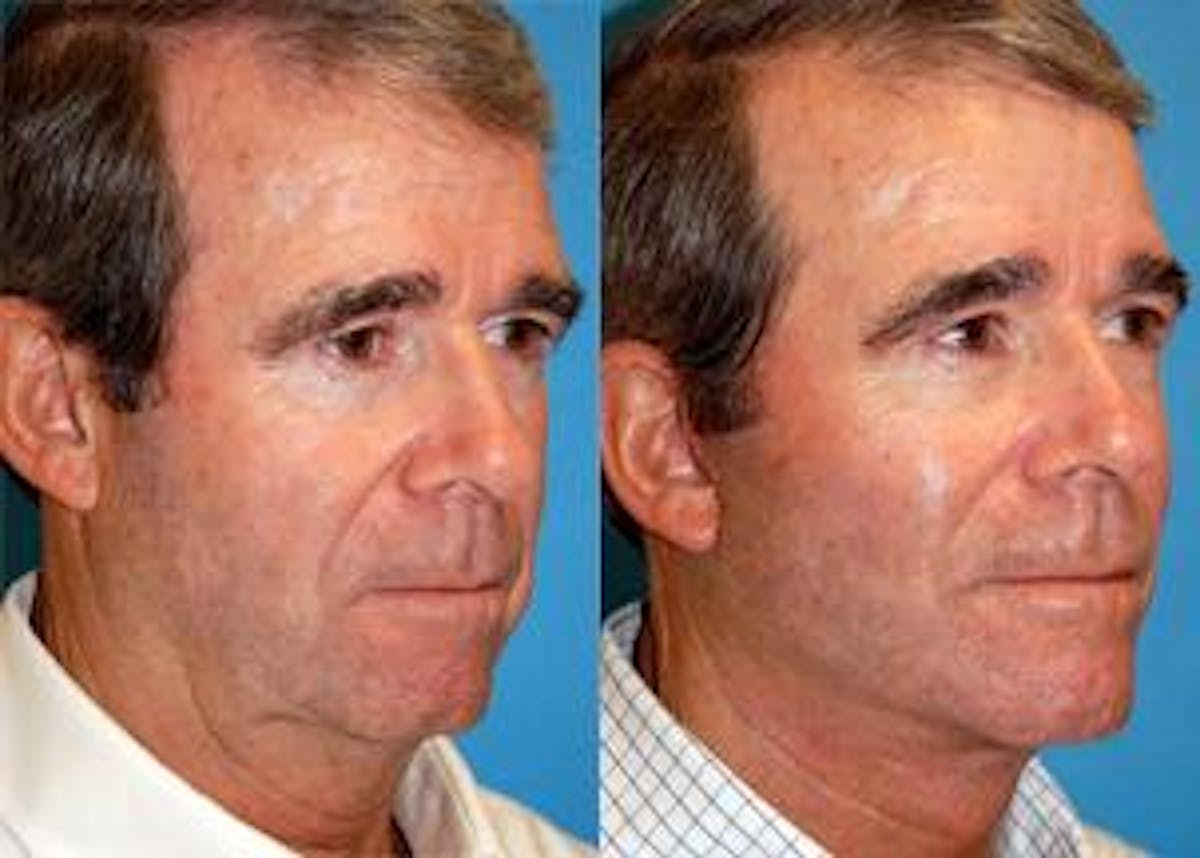 Male Facelift Before & After Gallery - Patient 122406239 - Image 3