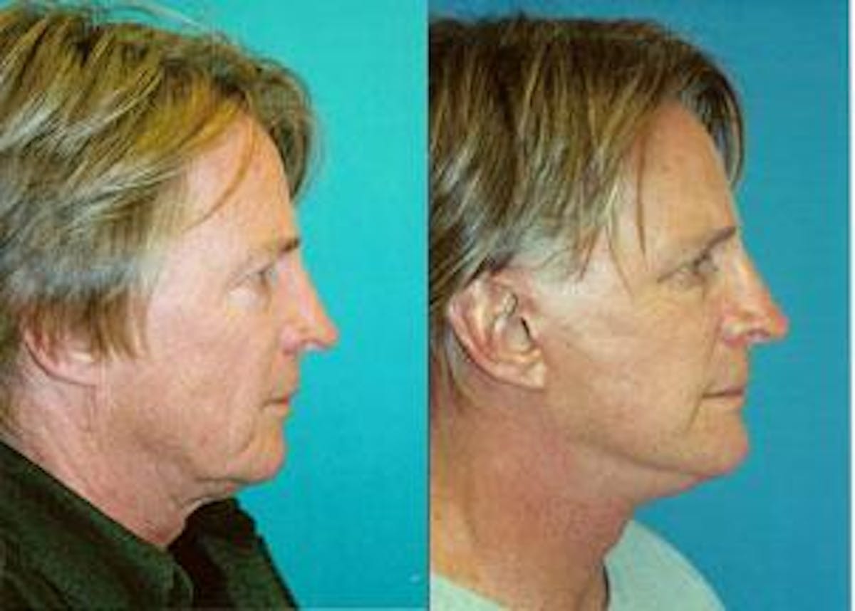 Male Facelift Before & After Gallery - Patient 122406242 - Image 1