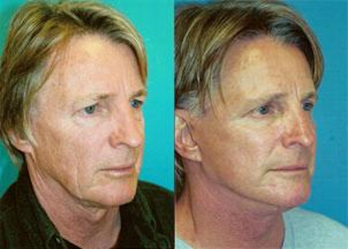 Male Facelift Before & After Gallery - Patient 122406242 - Image 2