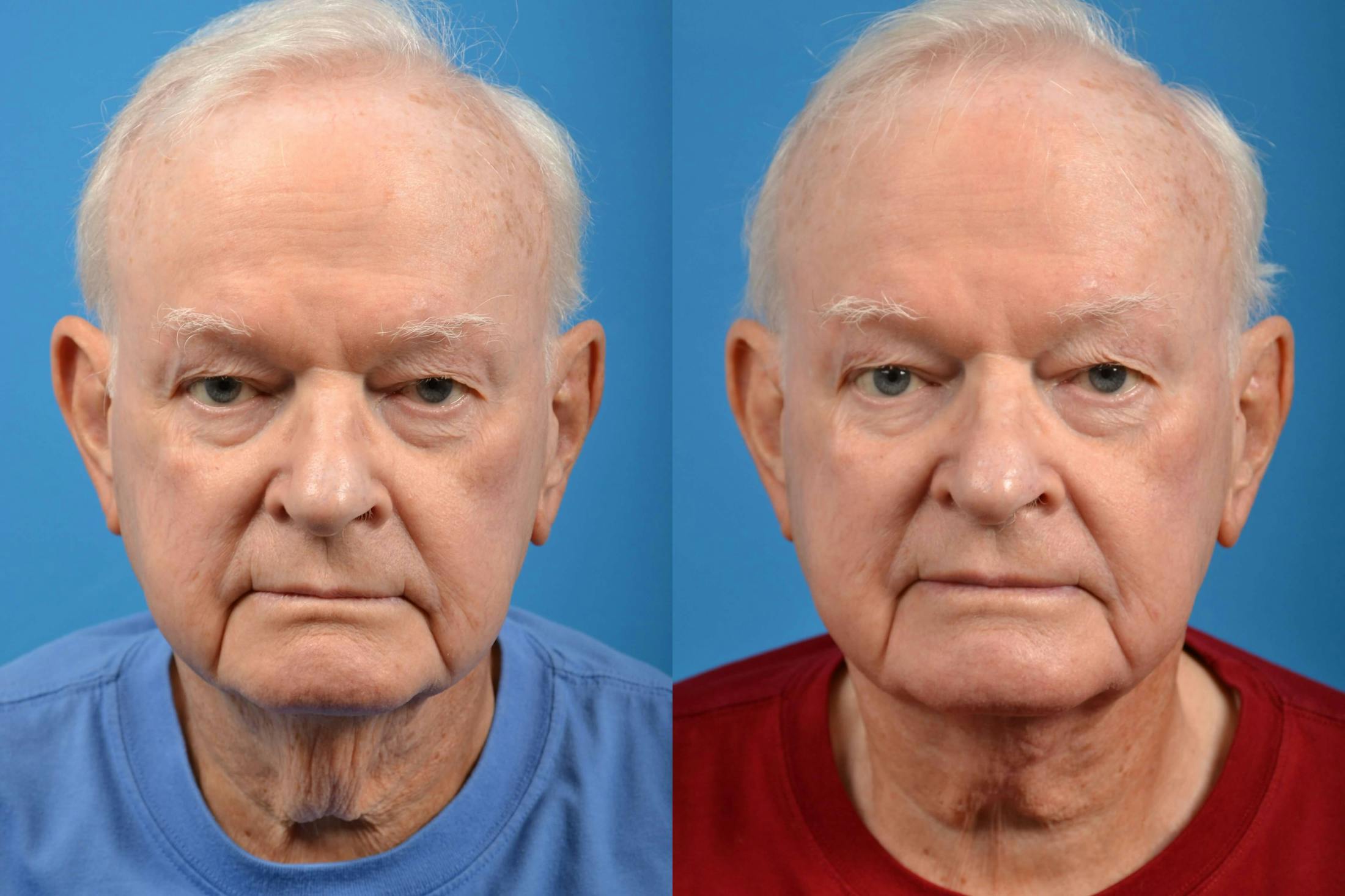 Male Neck Lift Before & After Gallery - Patient 122406260 - Image 1