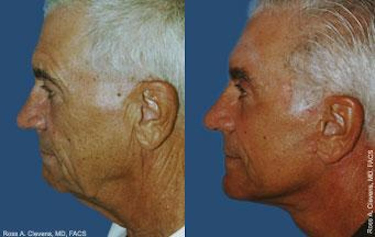 Male Facelift Before & After Gallery - Patient 122406249 - Image 2