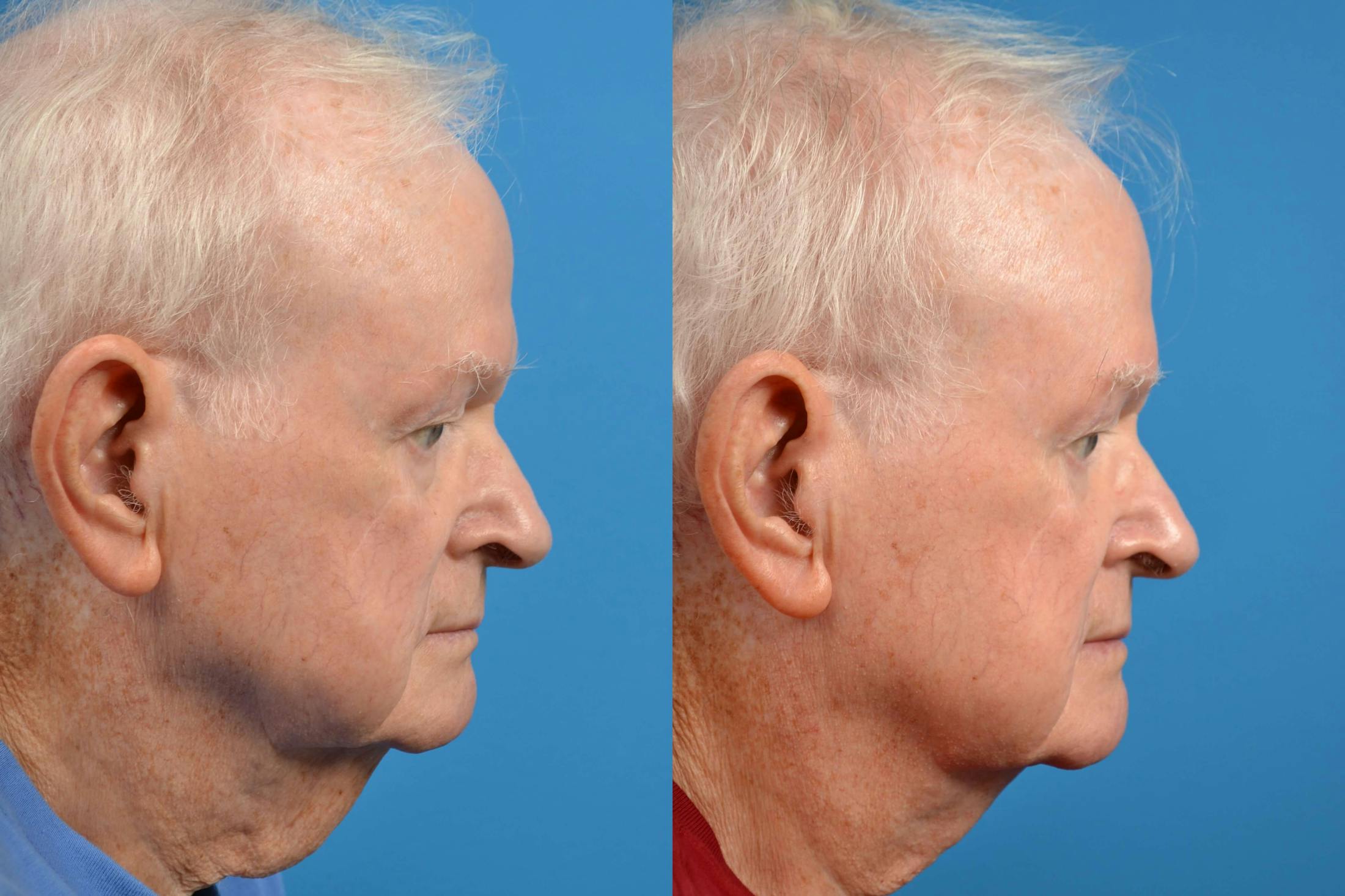 Male Neck Lift Before & After Gallery - Patient 122406260 - Image 2