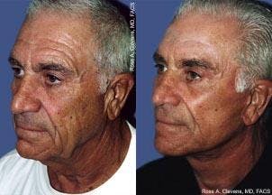 Male Facelift Before & After Gallery - Patient 122406249 - Image 3