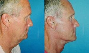 Male Facelift Before & After Gallery - Patient 122406254 - Image 1