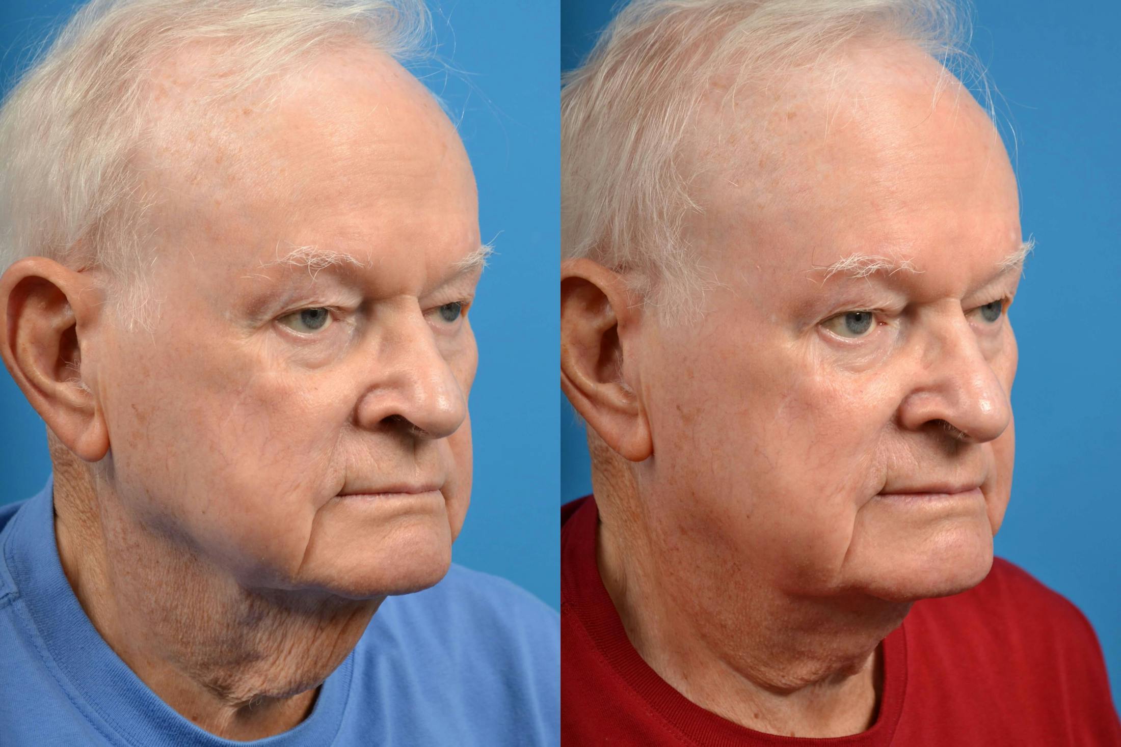 Male Neck Lift Before & After Gallery - Patient 122406260 - Image 3