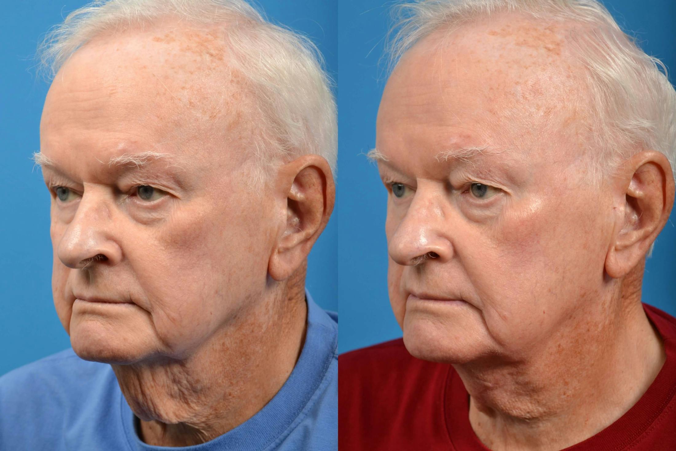 Male Neck Lift Before & After Gallery - Patient 122406260 - Image 4