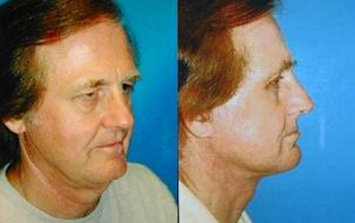 Male Facelift Before & After Gallery - Patient 122406258 - Image 2