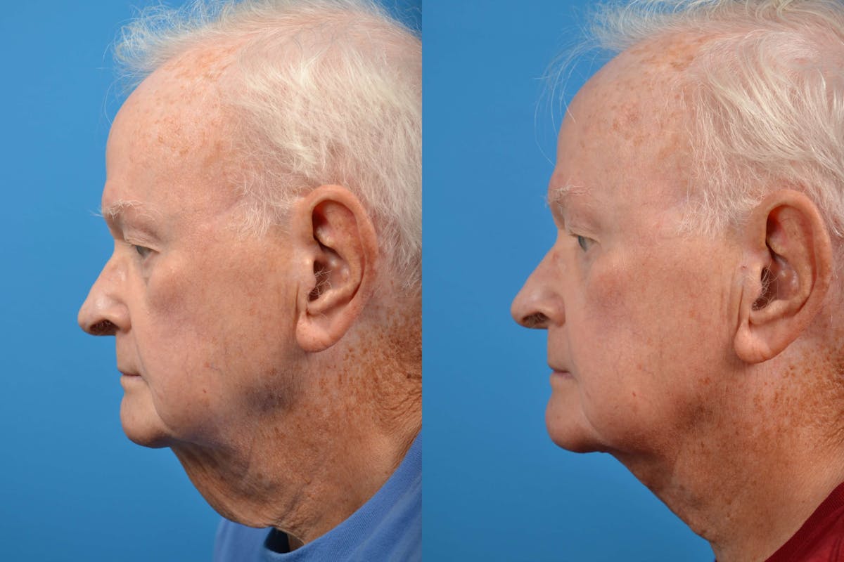Male Neck Lift Before & After Gallery - Patient 122406260 - Image 5