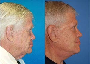Male Facelift Gallery - Patient 122406264 - Image 1