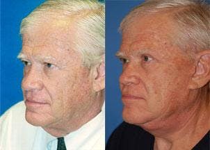 Male Facelift Before & After Gallery - Patient 122406264 - Image 2
