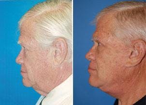 Male Facelift Gallery - Patient 122406264 - Image 3