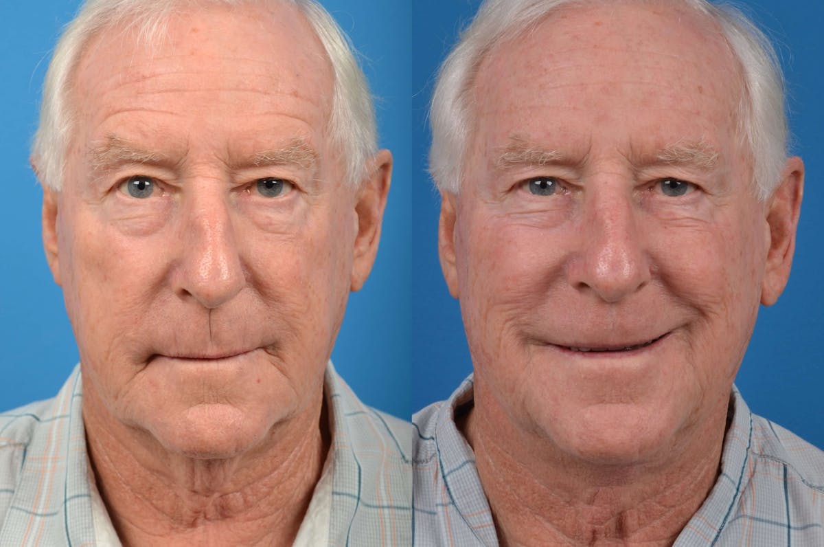 Male Neck Lift Before & After Gallery - Patient 122406273 - Image 1