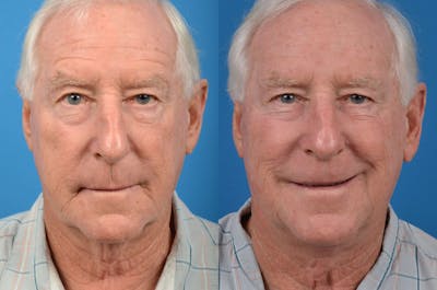 Male Neck Lift Before & After Gallery - Patient 122406273 - Image 1