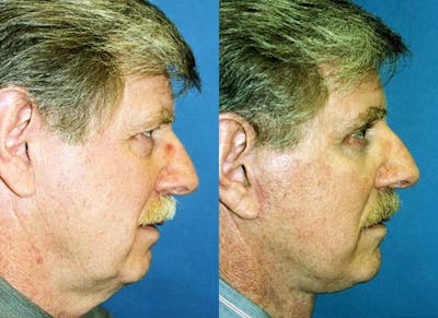 Male Facelift Before & After Gallery - Patient 122406265 - Image 1