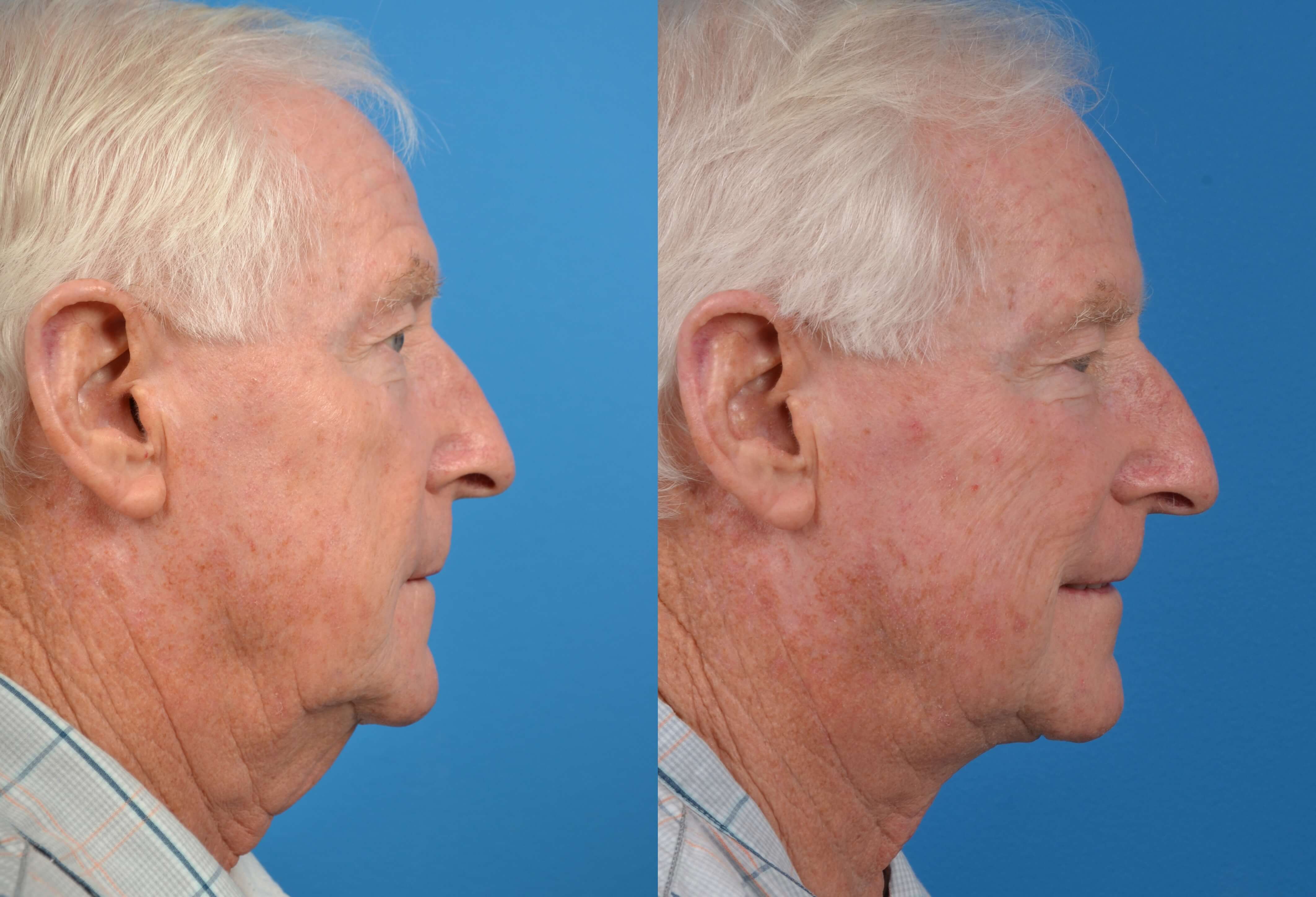 Patient 122406273 Male Neck Lift Before & After Photos Clevens Face