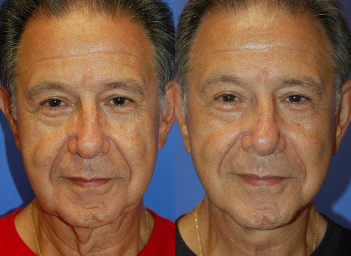 Male Facelift Before & After Gallery - Patient 122406270 - Image 1