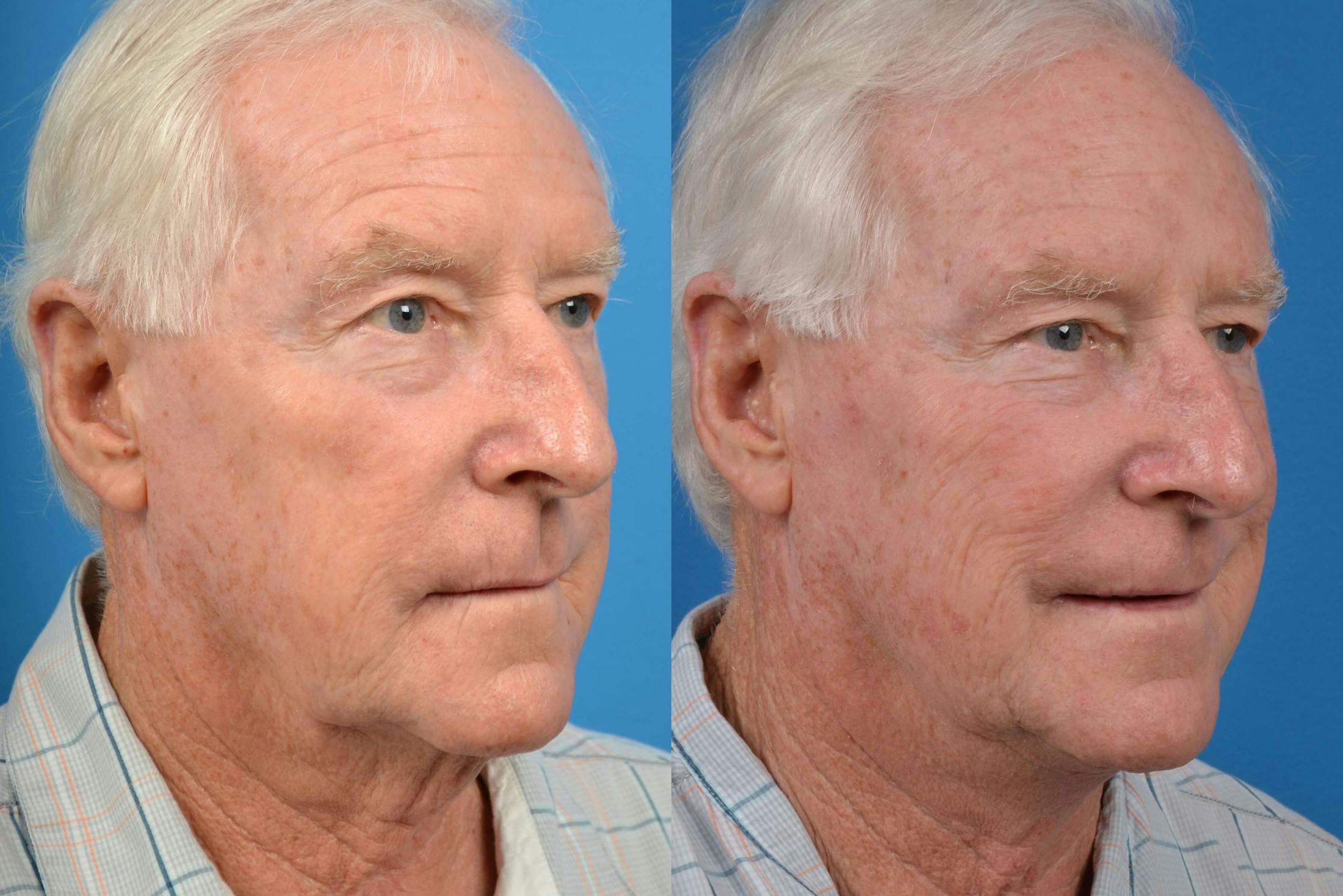 Male Neck Lift Before & After Gallery - Patient 122406273 - Image 3