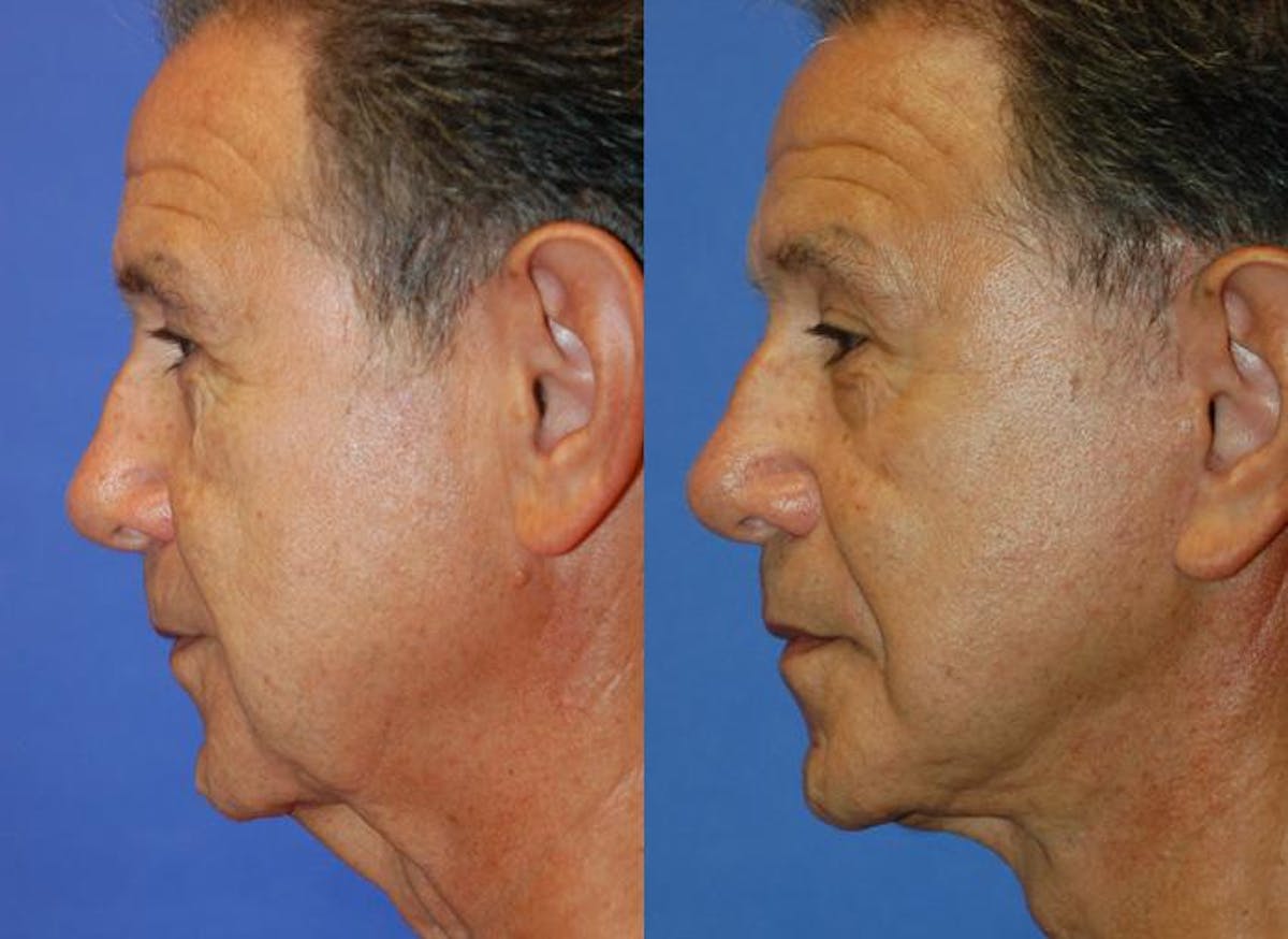 Male Facelift Before & After Gallery - Patient 122406270 - Image 2