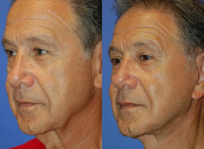 Male Facelift Before & After Gallery - Patient 122406270 - Image 3