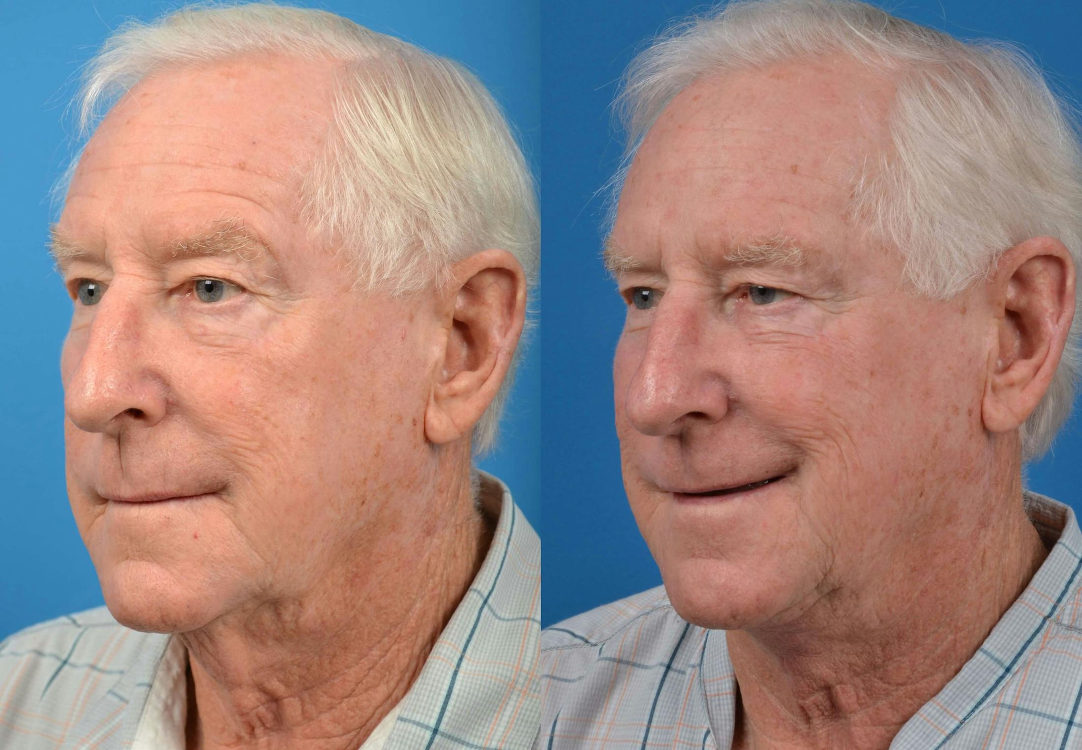 Male Neck Lift Before & After Gallery - Patient 122406273 - Image 4