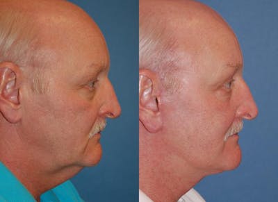 Male Facelift Before & After Gallery - Patient 122406272 - Image 1