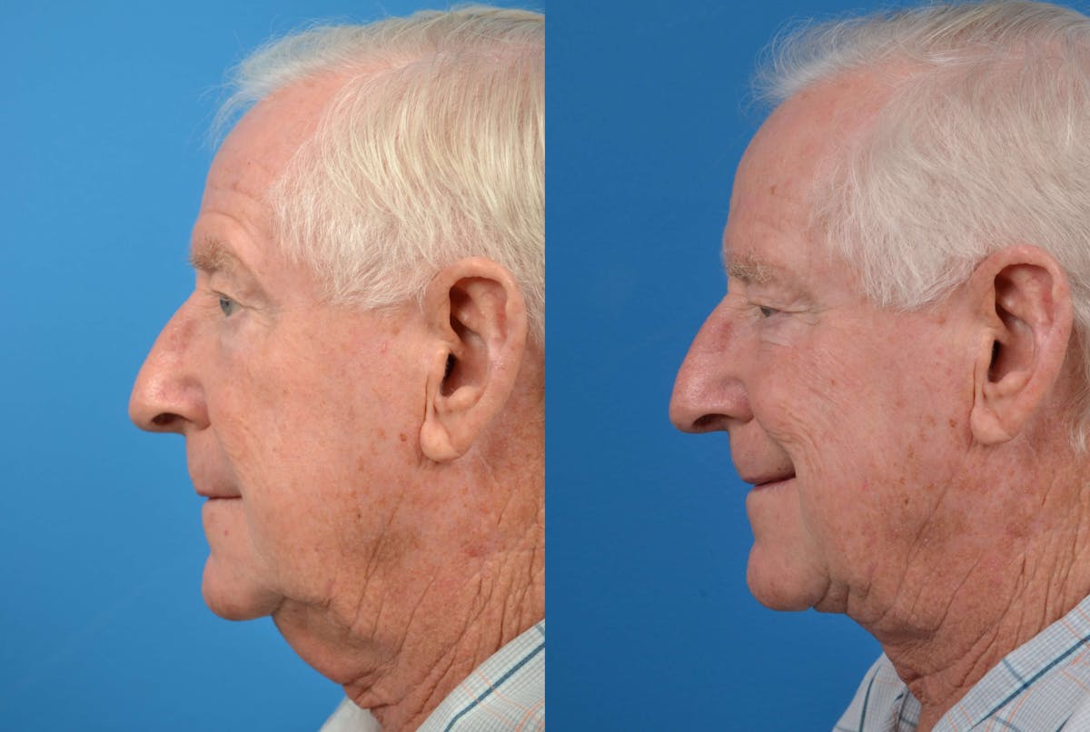 Male Neck Lift Before & After Gallery - Patient 122406273 - Image 5