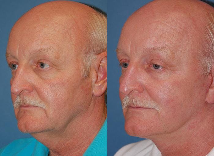 Male Facelift Before & After Gallery - Patient 122406272 - Image 2