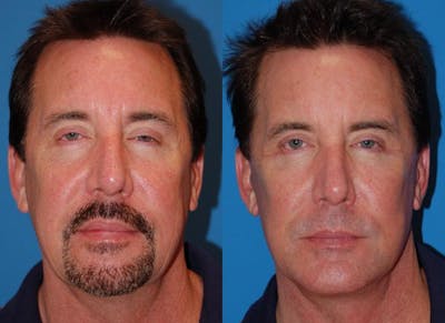 Male Facelift Before & After Gallery - Patient 122406275 - Image 1