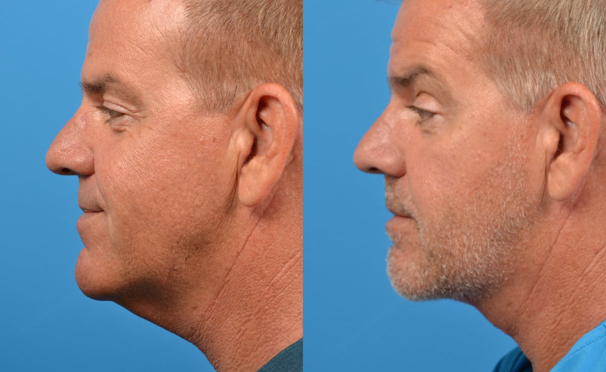 Male Neck Lift Before & After Gallery - Patient 122406281 - Image 1