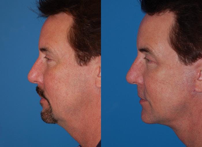 Male Facelift Before & After Gallery - Patient 122406275 - Image 2
