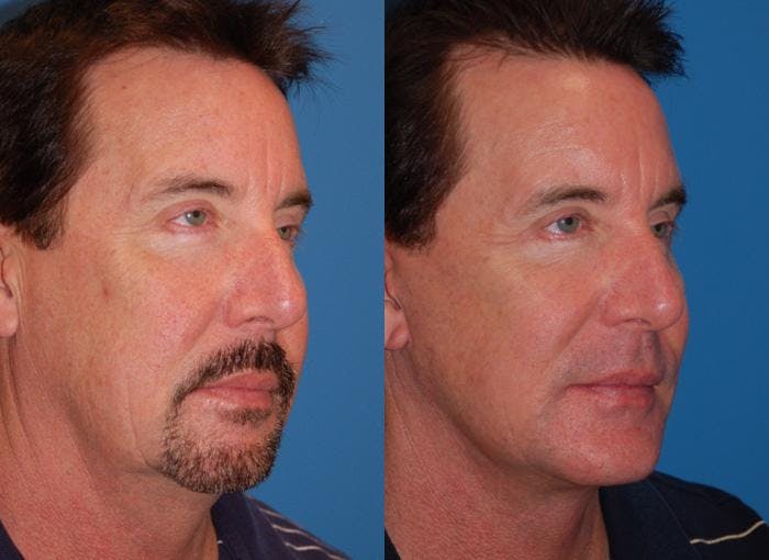 Male Facelift Before & After Gallery - Patient 122406275 - Image 3